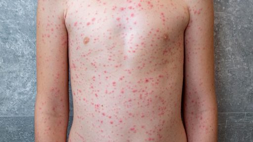 Measles