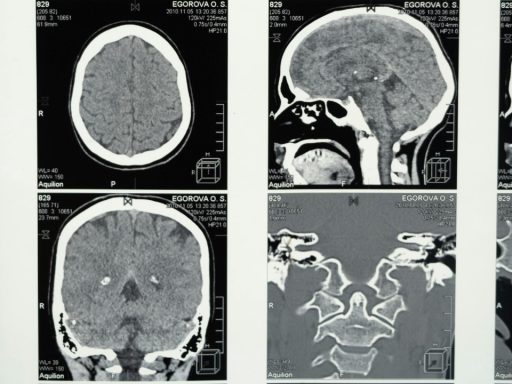 Brain tumor