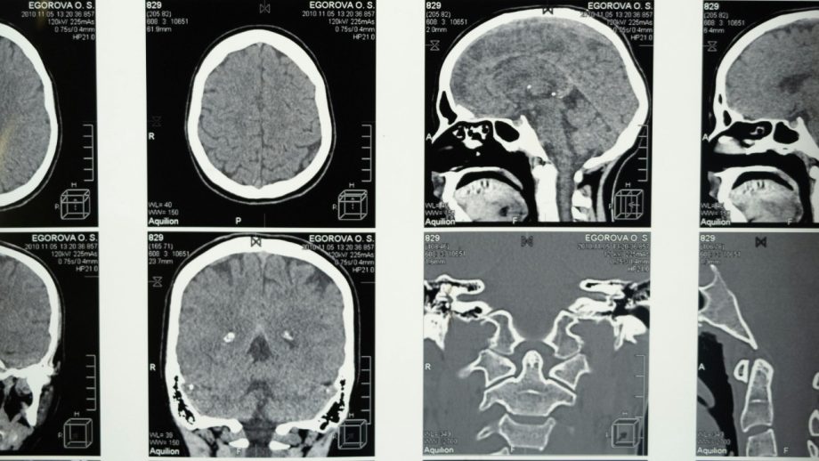 Brain tumor