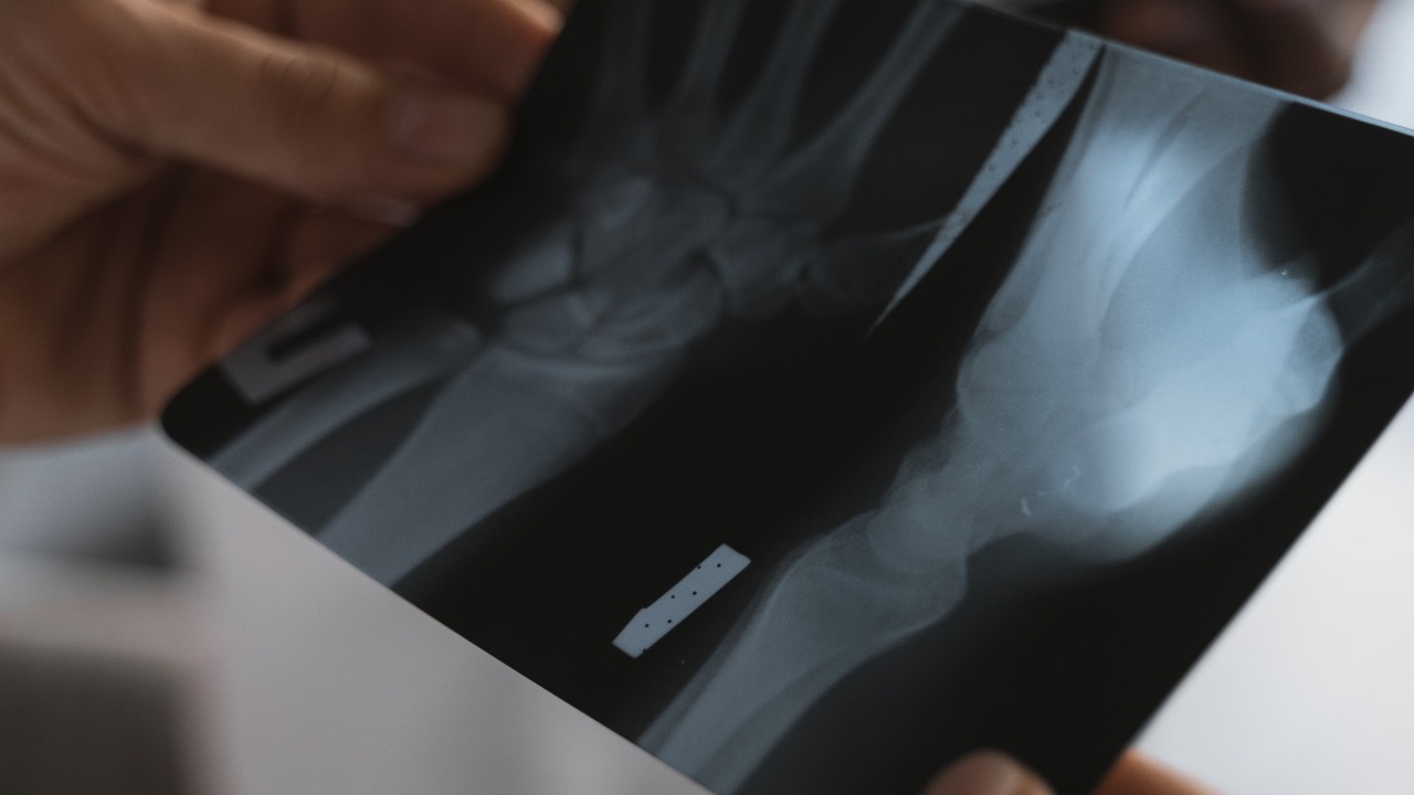 X-Rays