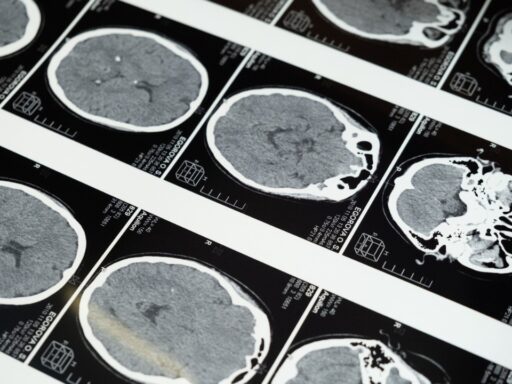 brain